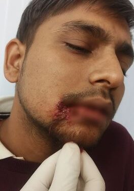 Attempt to snatch a bag full of jewelery from a bullion trader, grocery trader injured due to bullet injury