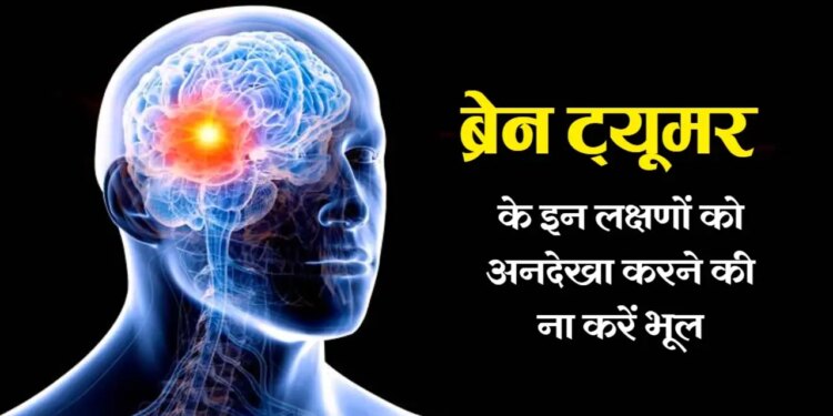 ब्रेन ट्यूमर का शुरुआती चेतावनी संकेत हो सकता है आम सिरदर्द, डॉक्टर ने बताई समय रहते जांच की जरूरी बातें