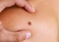 Early symptoms of skin cancer which can be dangerous if ignored, consult a doctor immediately