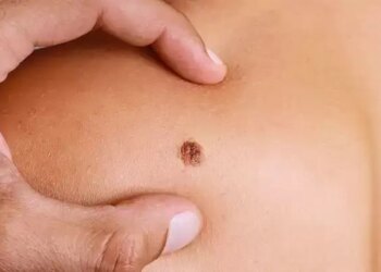 Early symptoms of skin cancer which can be dangerous if ignored, consult a doctor immediately