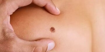 Early symptoms of skin cancer which can be dangerous if ignored, consult a doctor immediately