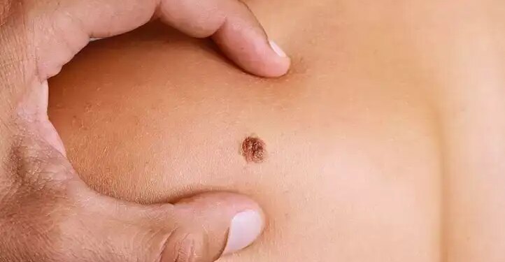 Early symptoms of skin cancer which can be dangerous if ignored, consult a doctor immediately