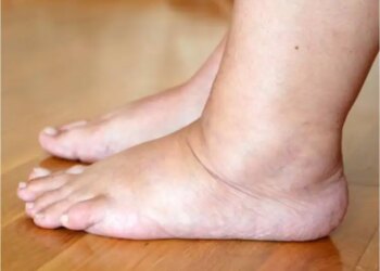 Leg Swelling Warning:&nbsp;पैरों में सूजन को न करें नजरअंदाज़, हो सकता है इन तीन अंगों के फेलियर का संकेत&nbsp;