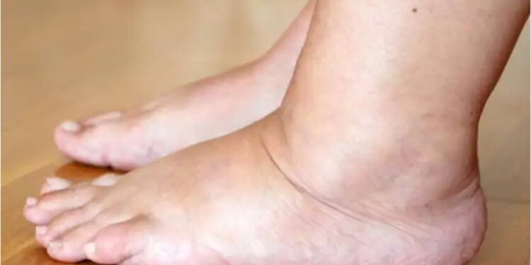 Leg Swelling Warning:&nbsp;पैरों में सूजन को न करें नजरअंदाज़, हो सकता है इन तीन अंगों के फेलियर का संकेत&nbsp;