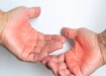 Prevention from dengue is very important, relief can be found with home remedies