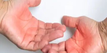 Prevention from dengue is very important, relief can be found with home remedies