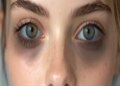 Dark Circles: These dark circles around the eyes also indicate physical fatigue.