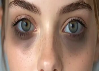 Dark Circles: These dark circles around the eyes also indicate physical fatigue.