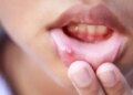 Repeated mouth ulcers are a sign of increased bile in the body, ignoring them may prove costly.