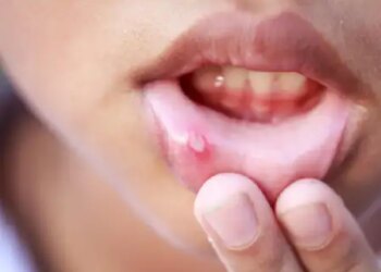 Repeated mouth ulcers are a sign of increased bile in the body, ignoring them may prove costly.