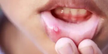 Repeated mouth ulcers are a sign of increased bile in the body, ignoring them may prove costly.