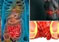 Warning to youth! If you see these 5 initial signs of Colon Cancer, consult a doctor immediately, ignoring it may prove costly.