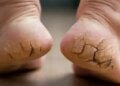 With this Ayurvedic remedy you will get relief from cracked heels, they can become soft again.