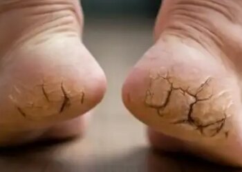 With this Ayurvedic remedy you will get relief from cracked heels, they can become soft again.