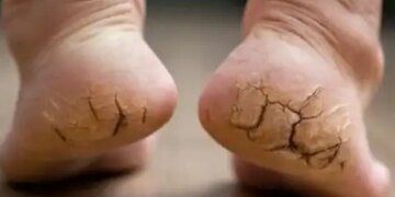 With this Ayurvedic remedy you will get relief from cracked heels, they can become soft again.