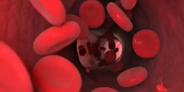 3 remedies of Ayurveda will remove the problem of anemia, some special things have to be kept in mind