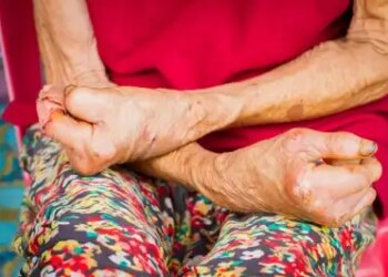 Leprosy Day: Treatment is easy, real enemy is stigma and discrimination.