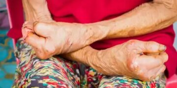 Leprosy Day: Treatment is easy, real enemy is stigma and discrimination.
