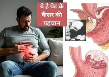 These 5 symptoms are seen in the beginning of stomach cancer, if ignored it can be life threatening.