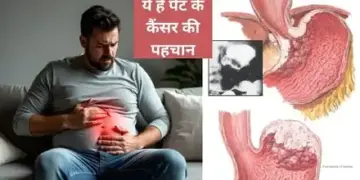 These 5 symptoms are seen in the beginning of stomach cancer, if ignored it can be life threatening.