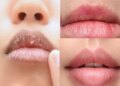 Why are lips the most dry in winter? Know the reasons and lip care tips from experts