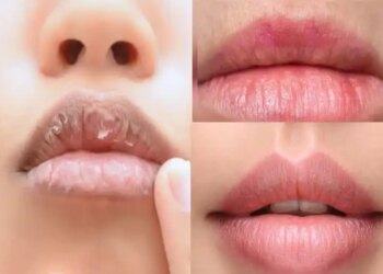 Why are lips the most dry in winter? Know the reasons and lip care tips from experts