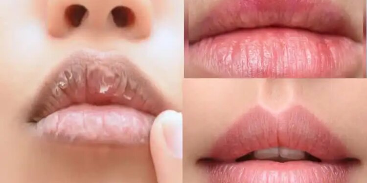 Why are lips the most dry in winter? Know the reasons and lip care tips from experts