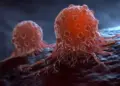 Cancer remains silent in the beginning! Why people are not able to recognize its early signs in time?