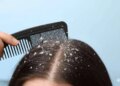 Home remedy for dandruff and itching: Prepare 3 effective hair masks with curd and get silky hair.