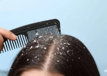 Home remedy for dandruff and itching: Prepare 3 effective hair masks with curd and get silky hair.