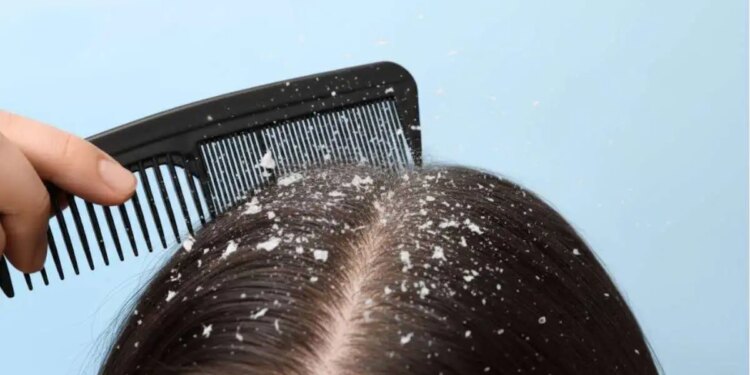 Home remedy for dandruff and itching: Prepare 3 effective hair masks with curd and get silky hair.