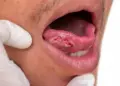 Oral Cancer Alert: Mouth sores are not alarm bells! Wounds that do not heal for 2 weeks can be a symptom of cancer.
