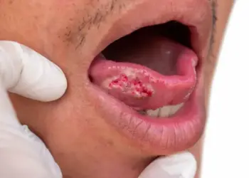Oral Cancer Alert: Mouth sores are not alarm bells! Wounds that do not heal for 2 weeks can be a symptom of cancer.