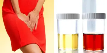 Dangerous reasons behind blood in urine, it is important to recognize it on time, otherwise your life may be in trouble.