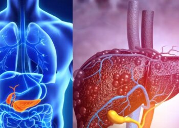 Fatty Liver Disease: These 8 habits of yours can make your liver sick, cases are increasing rapidly.