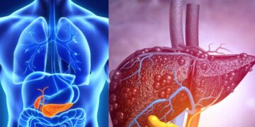 Fatty Liver Disease: These 8 habits of yours can make your liver sick, cases are increasing rapidly.