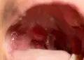 Health Alert: What is the first sign of tonsil cancer? Know the initial symptoms and method of identification