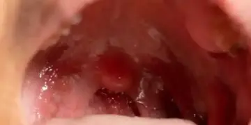 Health Alert: What is the first sign of tonsil cancer? Know the initial symptoms and method of identification