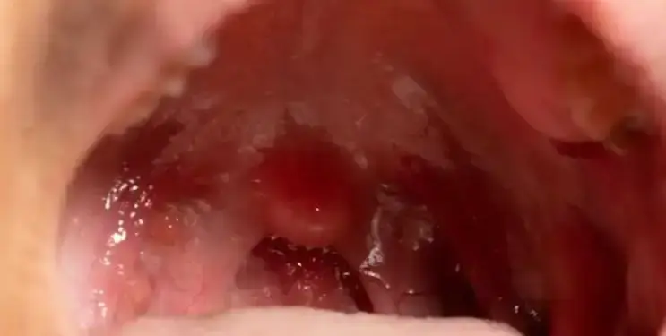 Health Alert: What is the first sign of tonsil cancer? Know the initial symptoms and method of identification