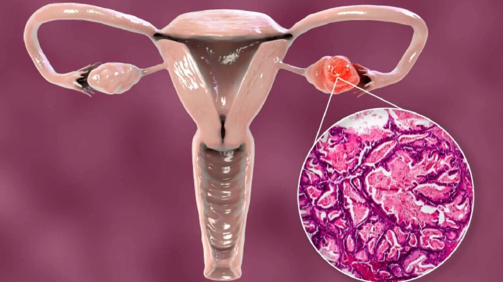 Ladies, take note! Is missing periods a sign of Ovarian Cancer? Know the opinion of experts.