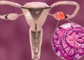 Ladies, take note! Is missing periods a sign of Ovarian Cancer? Know the opinion of experts.