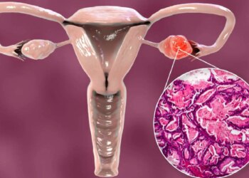 Ladies, take note! Is missing periods a sign of Ovarian Cancer? Know the opinion of experts.