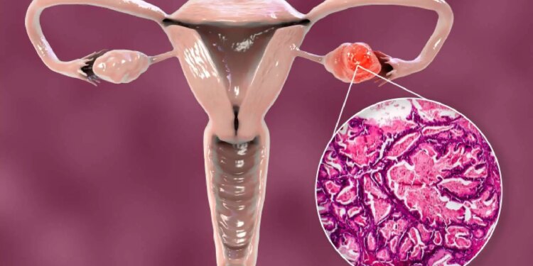 Ladies, take note! Is missing periods a sign of Ovarian Cancer? Know the opinion of experts.