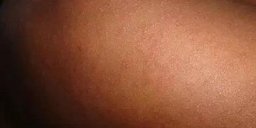 Measles outbreak increases in Nepal, appeal for vaccination