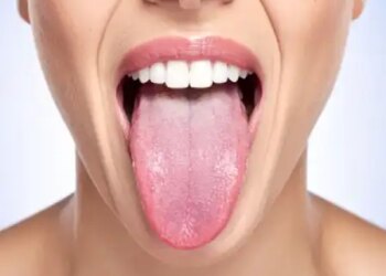 Tongue indicates imbalance of Tridosha, body disorders identified by color