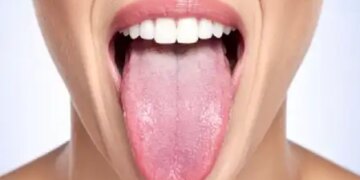 Tongue indicates imbalance of Tridosha, body disorders identified by color