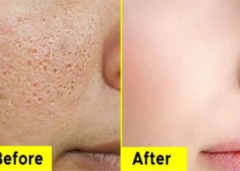 Has the glow of the skin faded due to large pores? Know easy and effective ways to reduce them