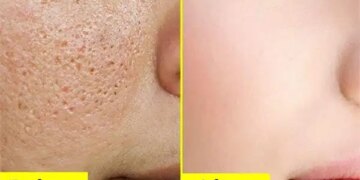 Has the glow of the skin faded due to large pores? Know easy and effective ways to reduce them