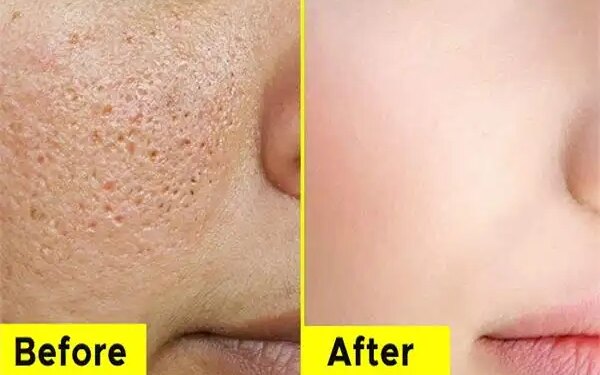 Has the glow of the skin faded due to large pores? Know easy and effective ways to reduce them