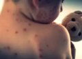 Pakistan: 71 children died due to measles in the first four months of this year.